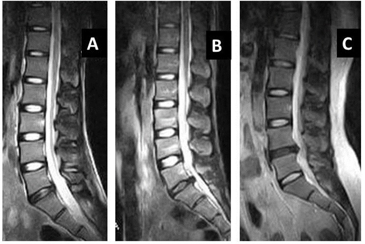 Correlation of Low Back Pain with Pathological Changes of Lumbar Spinal ...